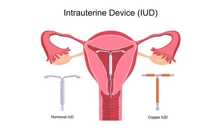 sterilet cupa menstruala
